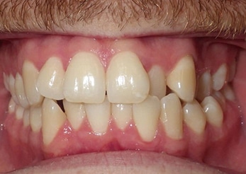 Combination Crowding Crossbite 10 Months Before