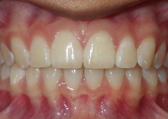 Combination Crowding Overbite 14months After
