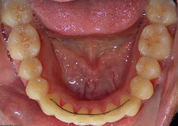 Combination Lower Crowding Crossbite 12 Months After