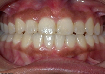Combination Open Bite Cross Bite Crowding 12months After