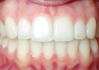 Crowding Invisalign Treatment Crowding Union County Nj 12months After