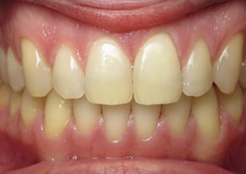 Spacing Invisalign Treatment Gap Teeth 14 Months After