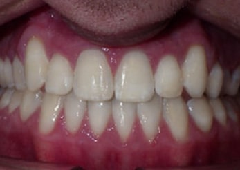 Combination Impacted Canines 16 Months After