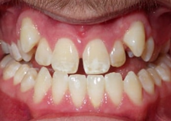 Combination Impacted Canines 16 Months Before
