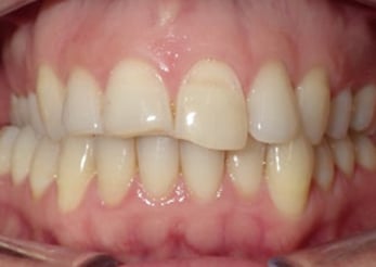 Combination Crossbite Crowding 12 Months Before