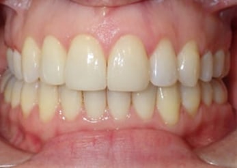 Combination Crossbite Crowding 12 Months After