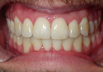 Combination Crowding Crossbite 10 Months After