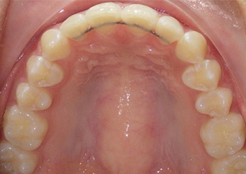 Combination Crowding Overbite 14months Teen After