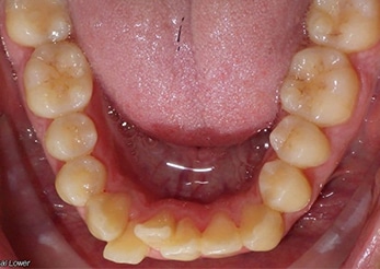 Combination Lower Crowding Crossbite 12 Months Before