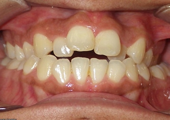 Combination Open Bite Cross Bite Crowding 12months Before