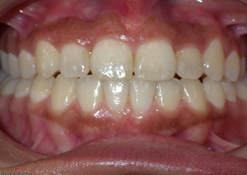 Combination Open Bite Cross Bite Crowding 12months After