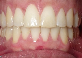 Combination Upper Spacing Overbite Lower Crowding 14months After