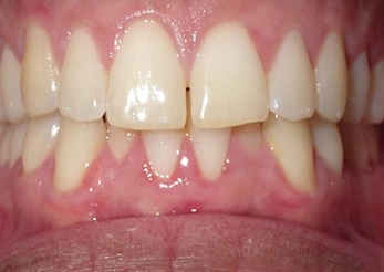 Combination Upper Spacing Overbite Lower Crowding 14months Before 