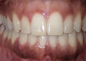 Cross Bite Spacing 12months After