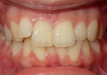 Crowding Invisalign Treatment Crowding Union County Nj 12months Before