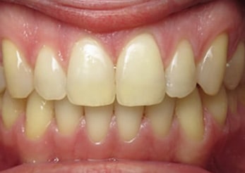 Spacing Invisalign Treatment Gap Teeth 14 Months After