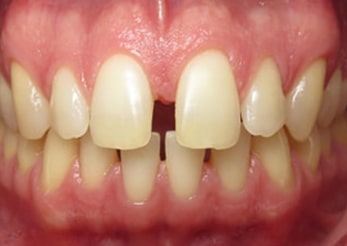 Spacing Invisalign Treatment Gap Teeth 14 Months Before
